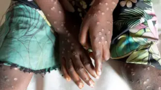 Africa No Longer Facing Mpox Emergency – Health Chief