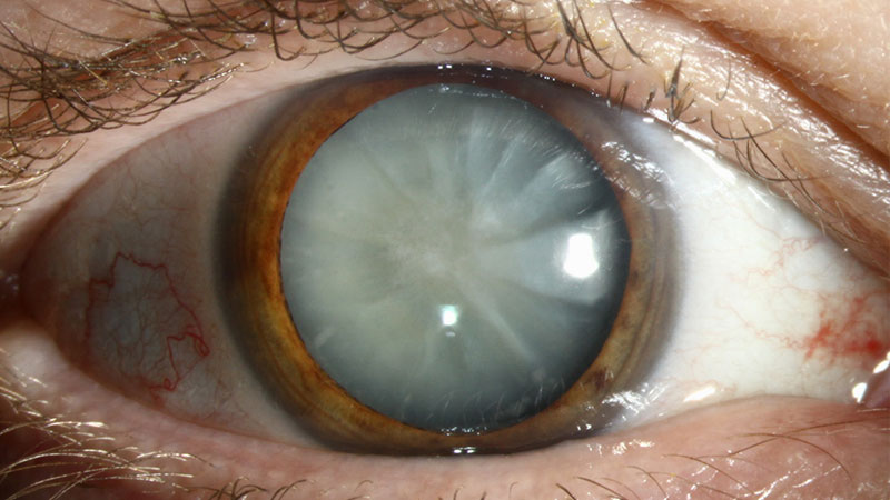 94 Million Need Cataract Surgery, WHO Says