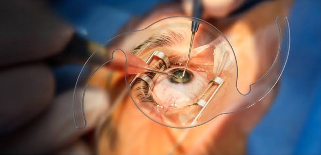 94 Million Need Cataract Surgery, WHO Says