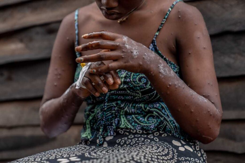 Ghana Reports 13 New Mpox Cases