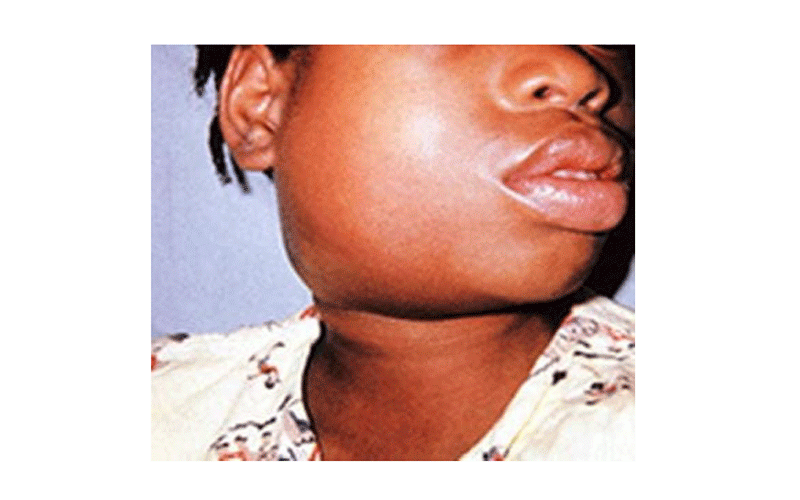 Mumps Cases Spread Across Nairobi Schools