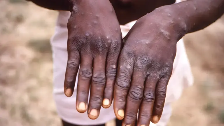 Benue State Debunks Mpox Outbreak