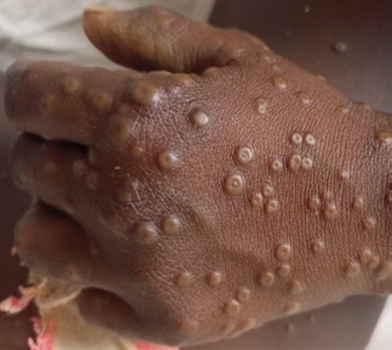 Benue on Alert Over Suspected Mpox Case