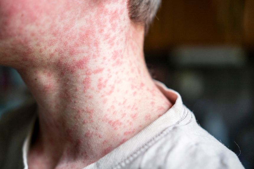 Measles (News Central TV)
