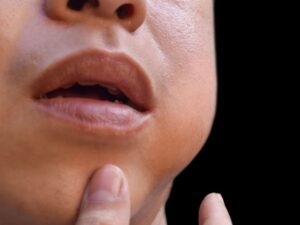 Mumps Cases Spread Across Nairobi Schools