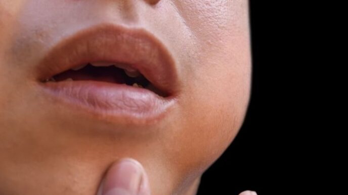Mumps Cases Spread Across Nairobi Schools