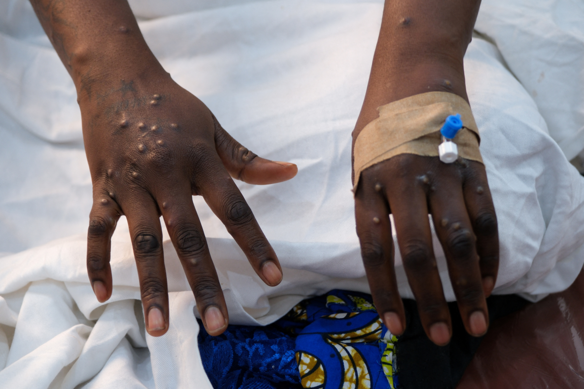 Guinea-Bissau faces first mpox outbreak (News Central TV)
