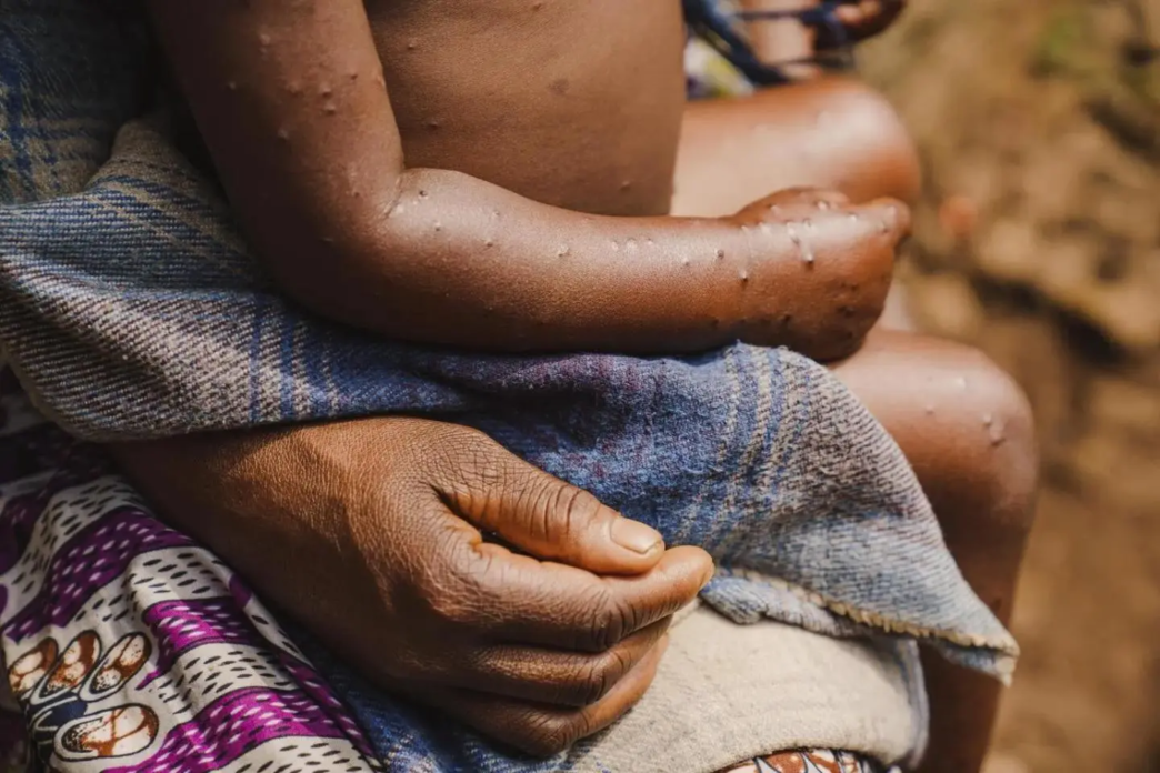 Guinea-Bissau faces first mpox outbreak (News Central TV)