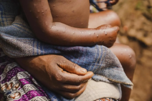 Guinea-Bissau faces first mpox outbreak (News Central TV)