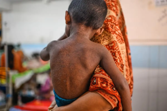 Measles Outbreak in Bangladesh Kills 1,000 Children