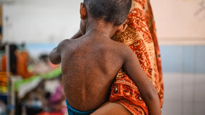 Measles Outbreak in Bangladesh Kills 1,000 Children