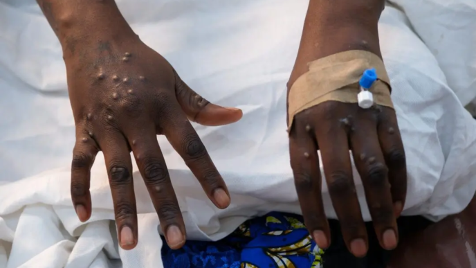 Mpox case confirmed in DR Congo's Bunia (News Central TV)