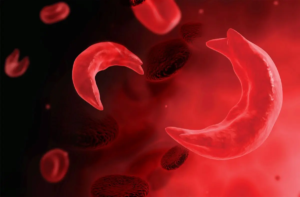 sickle_cell