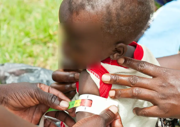 Ugandan Children Face Rising Malnutrition Crisis