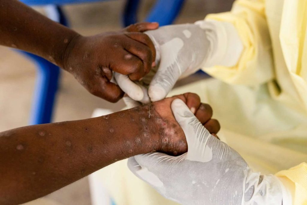 Africa Faces Funding Gap of Over $220 Million in Mpox Response Efforts