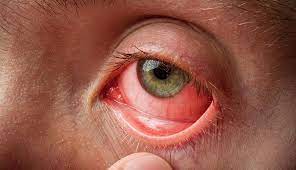 Concerns Rise as Conjunctivitis Outbreak Hits Ugandan Schools