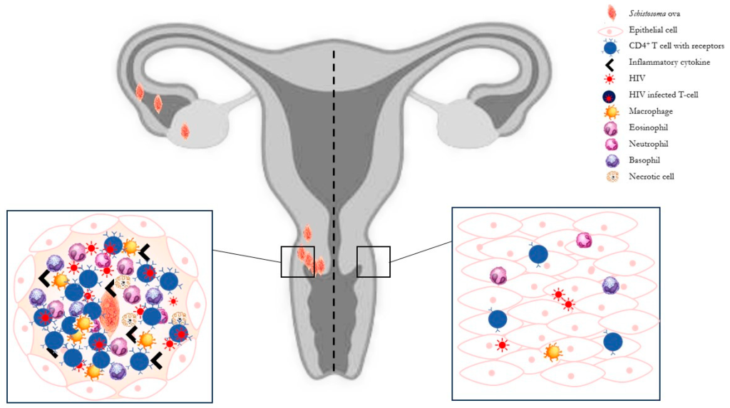 Concerns Rise as Female Genital Schistosomiasis is Linked to Infertility