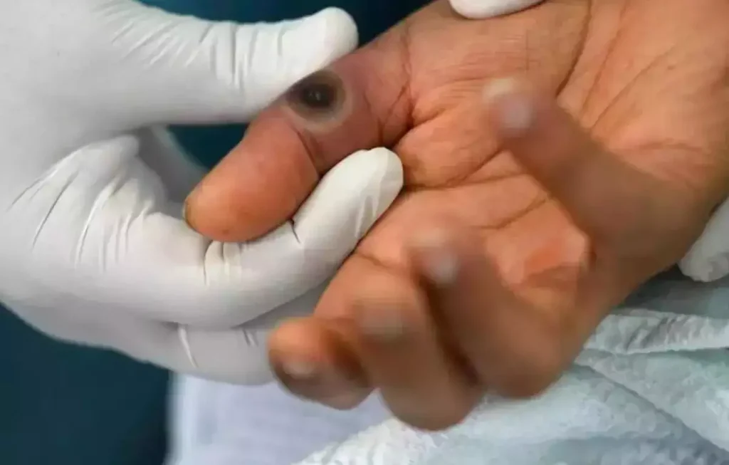 MPox: South Africa Records First Death