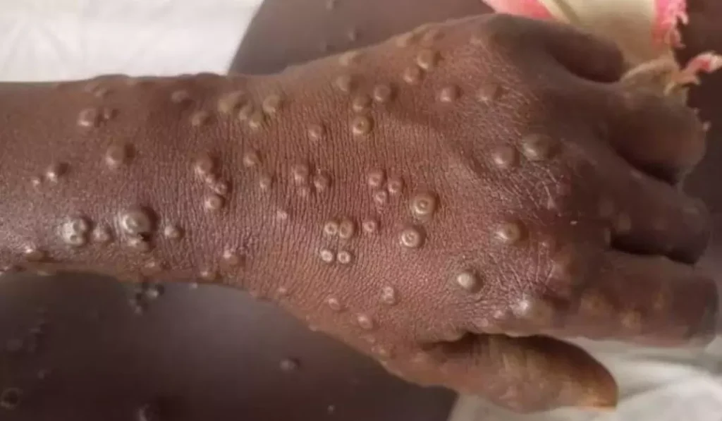 Mpox Cases Hit 133 in Ghana, Containment Intensifies