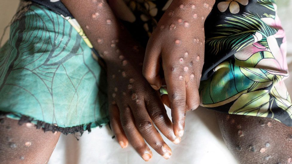 Mpox Spread Slows in Africa, But Epidemic Far From Over