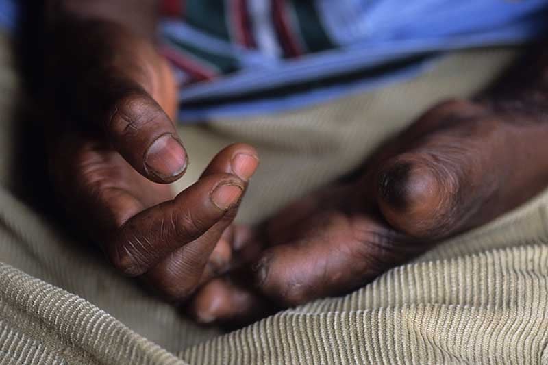 Nigeria to receive leprosy drugs after a year-long delay