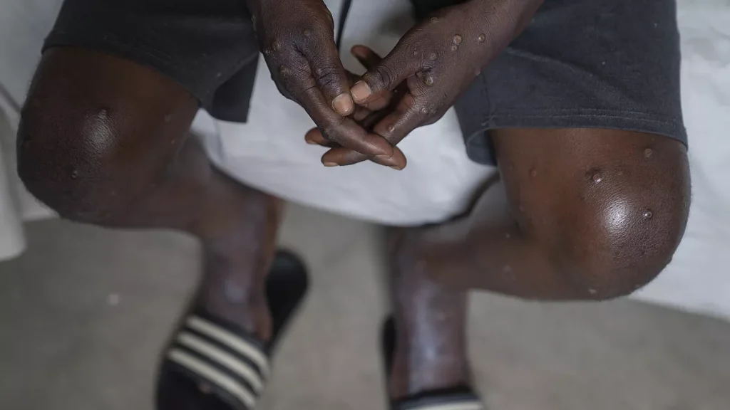 Nigerian Medical Association Urges Cross River to Bolster Mpox Surveillance