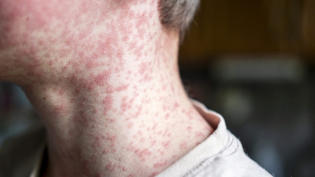 Texas Measles Outbreak Hits 90 Cases, Majority Unvaccinated