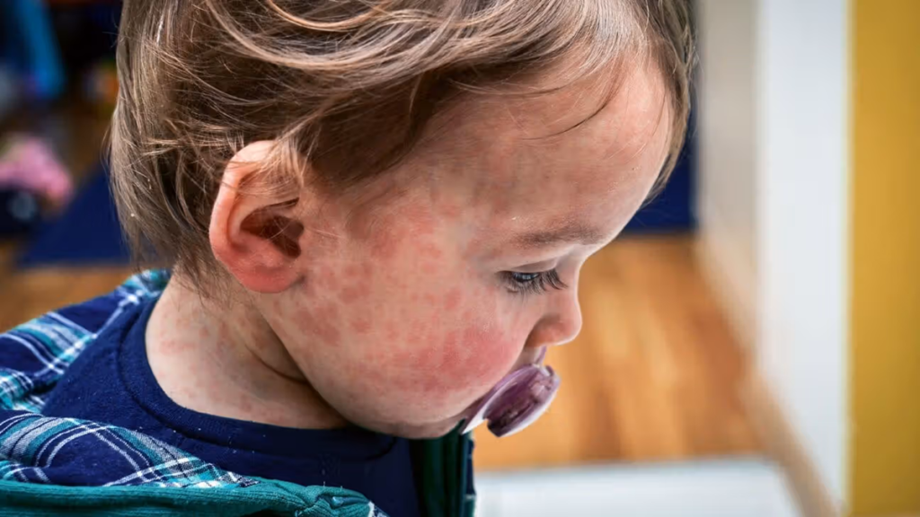 US Faces Worst Measles Spike in Decades