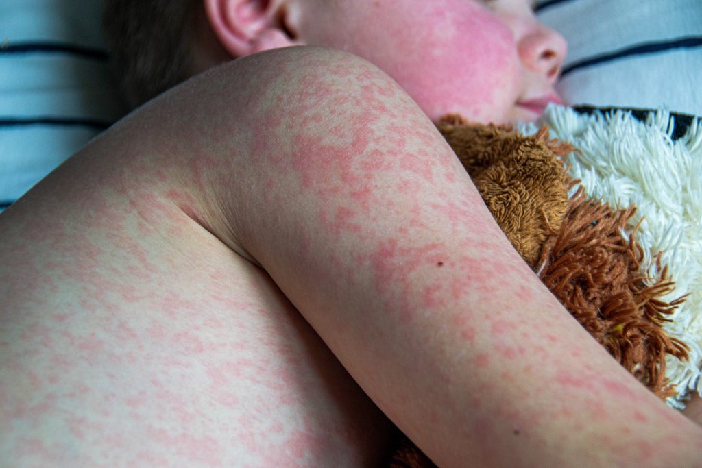 US Measles Outbreak Now Over 1,000 Cases, With Three Deaths