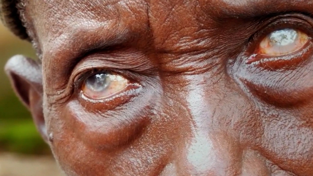 Niger Becomes First African Country to Eliminate River Blindness