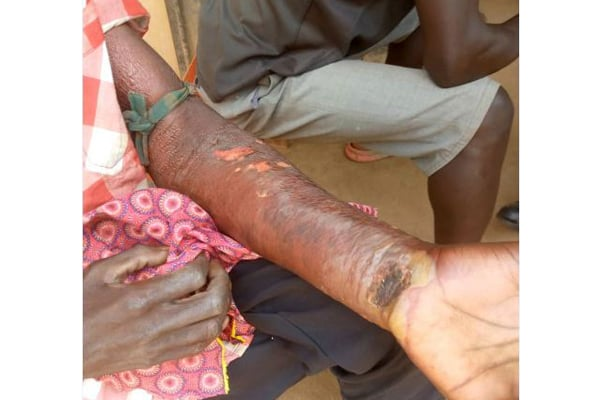 60 Families Struck by Strange Disease in Uganda, Health Officials Confirm